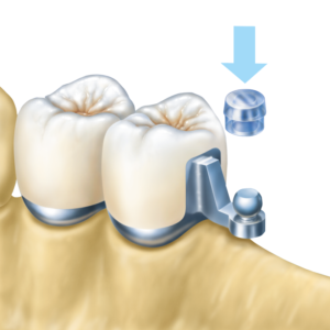 yatay-bilyalı-ankrajlar